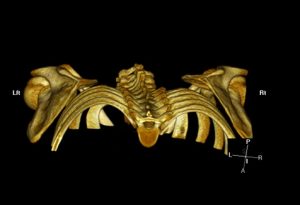 3D CT showing decreased Scapulothoracic distance on left side.