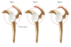 Acromial morpological patterns.(2)