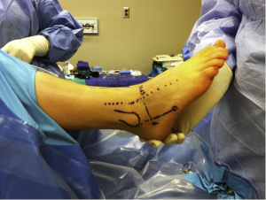 Position of Ankle during surgery