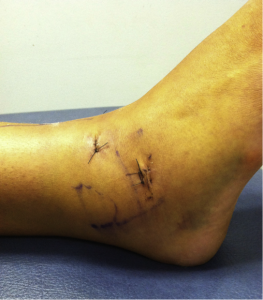 Ankle-arthroscopy-2