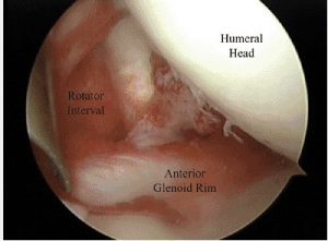 Arthroscopic Picture of Adhesive capsulitis