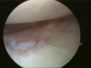 Picture above showing Labral detachment