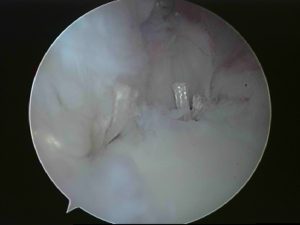 Picture showing completed Arthroscopic(key hole) repair.