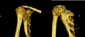 3D CT showing Cuff tear arthropathy