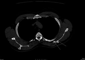 CT scan showing Lushkas Tubercle