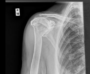 X ray showing Rotator cuff arthropathy