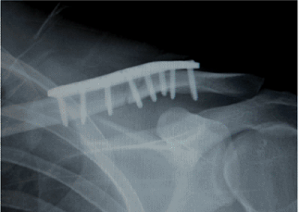 Post op Xrays showing Clavicle fixation