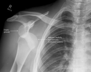 X rays showing dislocation of shoulder joint