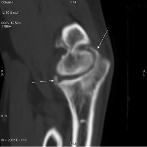 CT scan showing evidence of Elbow arthritis