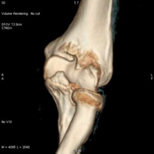 Elbow arthritis CT