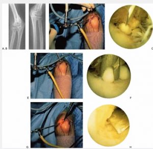 Elbow Arthroscopy