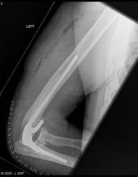 X ray showing Total Elbow Replacement