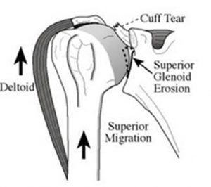 Diagram explaining Force couple of normal shoulder