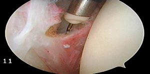 Arthroscopic release of Tight anterior interval