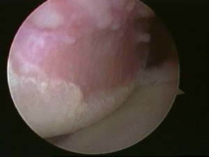 Arthroscopic picture showing Hill Sachs lesion