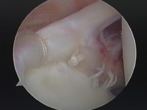 Arthroscopic view of final repair using Knotless anchors.