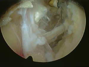 Arthroscopic view of Suprascapular nerve after release