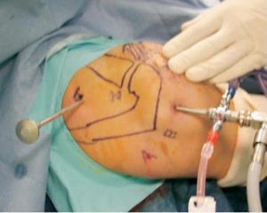 Surgeon performing key hole release of Suprascapular nerve