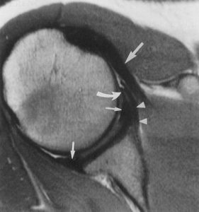 MRI Scan of shoulder showing labral injury