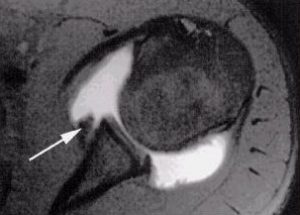 MR arthrogram image showing anterior labral injury (Bankart lesion)