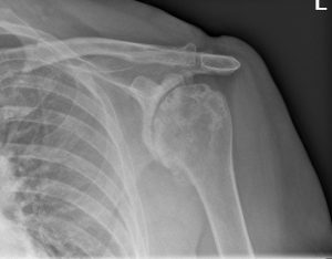 OA shoulder