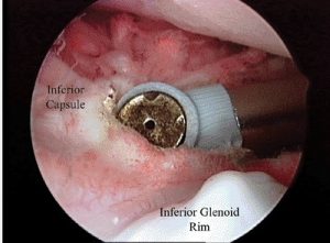 Arthroscopic release of inferior capsule