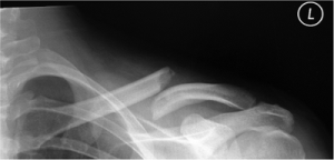 Pre op Xray of Mid third Clavicle fracture with 2 cm displacement