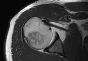 MR Arthrogram showing SLAP tear