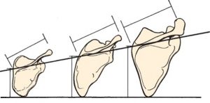 Shoulder infraspinous fossa