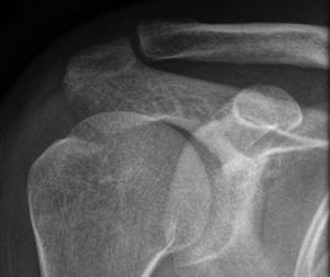 X ray of Normal AC joint