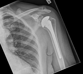 Total shoulder arthroplasty: Both the socket (glenoid) and the ball humeral head are replaced.