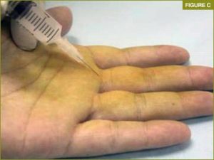 Steroid Injection into triggering site.