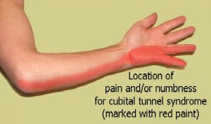 Ulnar nerve compression