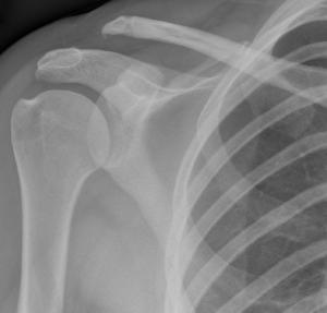 X rays Showing AC joint disruption