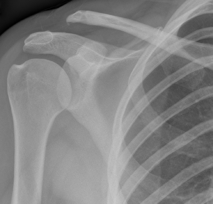 Acromioclavicular joint (AC) Disruption – speedhospitals.com