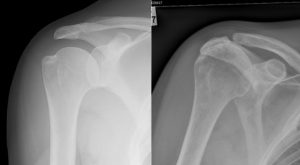 Normal xrays on left compared to Cuff tear arthopathy on right.