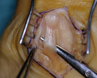 Intra operative picture showing release of Median Nerve