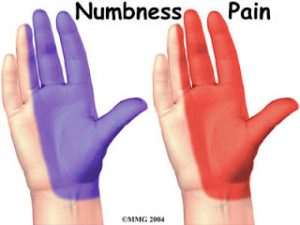 Areas of Numbness and Tingling in Carpal Tunnel Syndrome