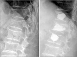 compression-fracture-kyphoplasty