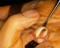 Picture showing released Tendon from constriction.